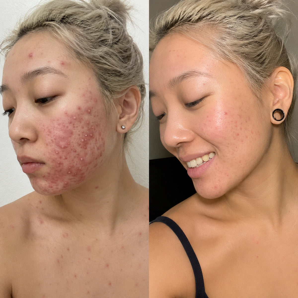 頬や額に赤みとニキビがある状態と、赤みが落ち着いて見える状態を並べた女性の比較イメージ。