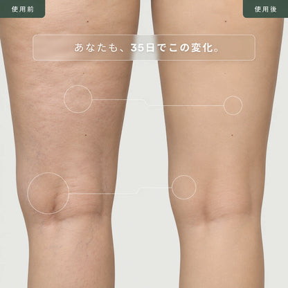 X4セルライトケアデバイス — EMS・SLIM・RF・SLIM+RFの4ケアモード